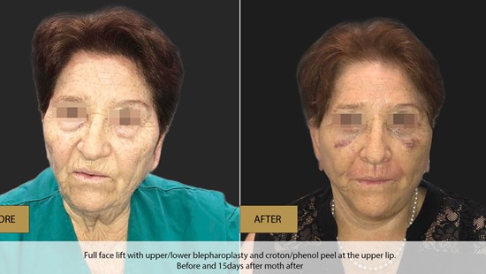 FACE LIFT