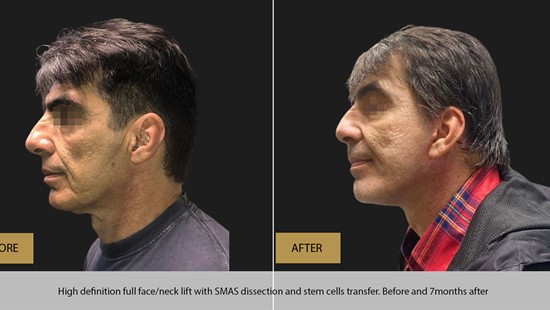 FACE LIFT