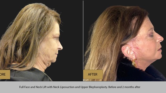 FACE LIFT