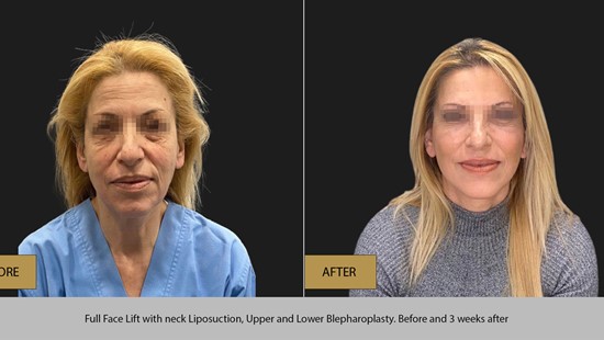 FACE LIFT