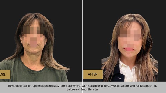 FACE LIFT