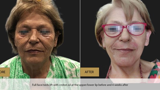 FACE LIFT