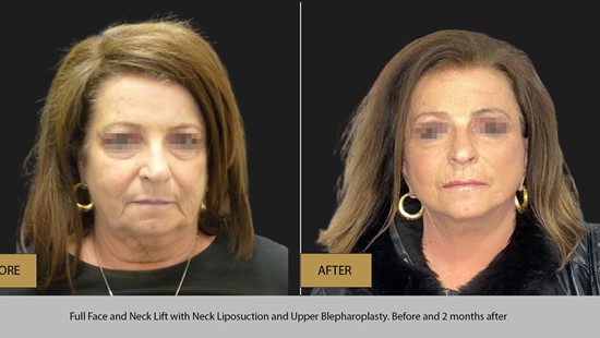 FACE LIFT